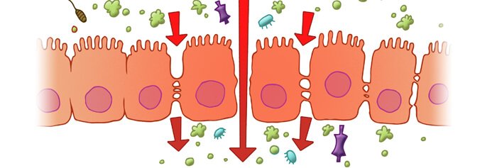 Leaky Gut Syndrome