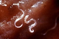 Human Hookworm Infection