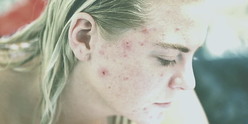 how to get rid of acne, natural treatment and food to avoid.